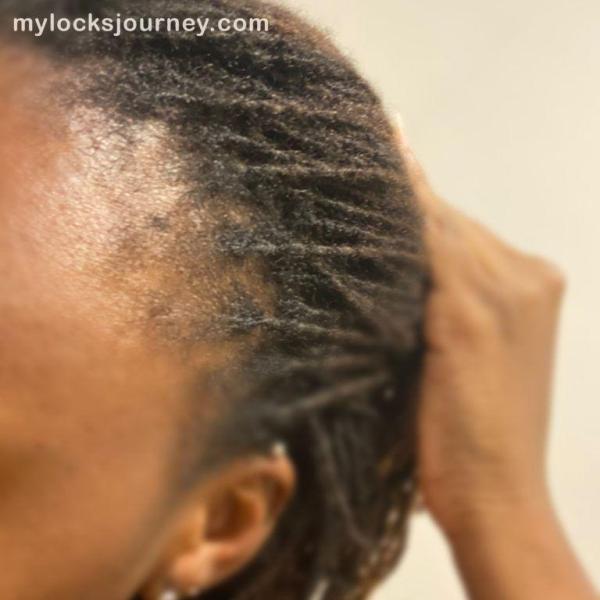 thinning hair edges - mylocksjourney.com 2