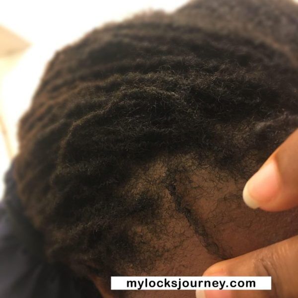thinning hair edges - mylocksjourney.com